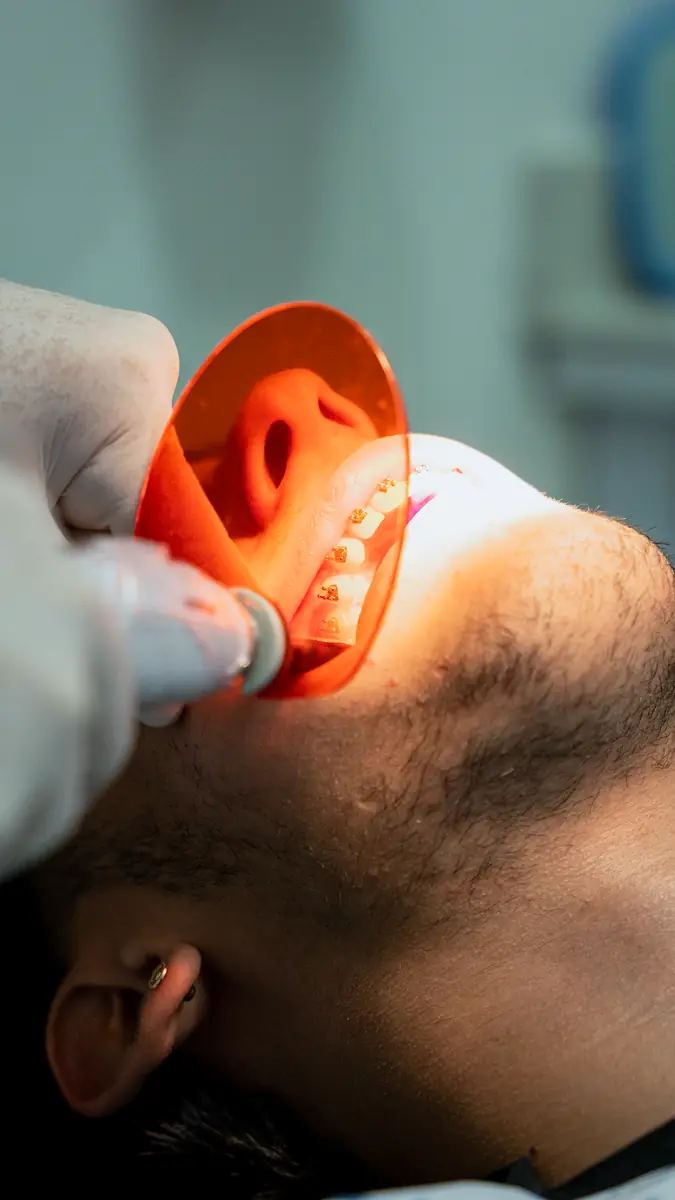 Orthodontic treatment with a curing light